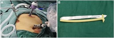 An alternative palliative surgical method for advanced malignant obstructive jaundice: Laparoscopic bridge choledochoduodenostomy